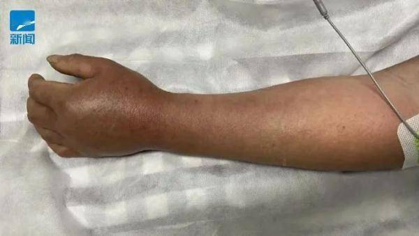 本年首例！杭州伯父去河滨洗手，成果被紧迫送医…